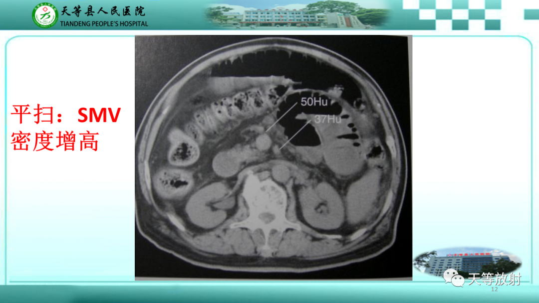 影像PPT - 【PPT】缺血性肠病的影像学表现-11