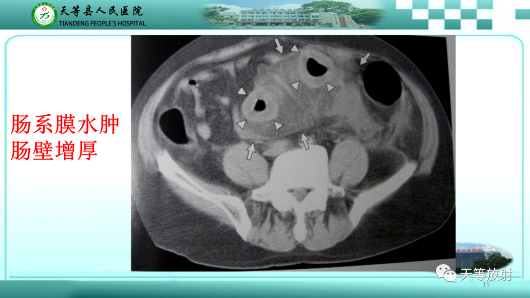 影像PPT - 【PPT】缺血性肠病的影像学表现-14