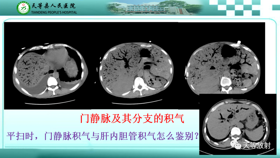 影像PPT - 【PPT】缺血性肠病的影像学表现-16