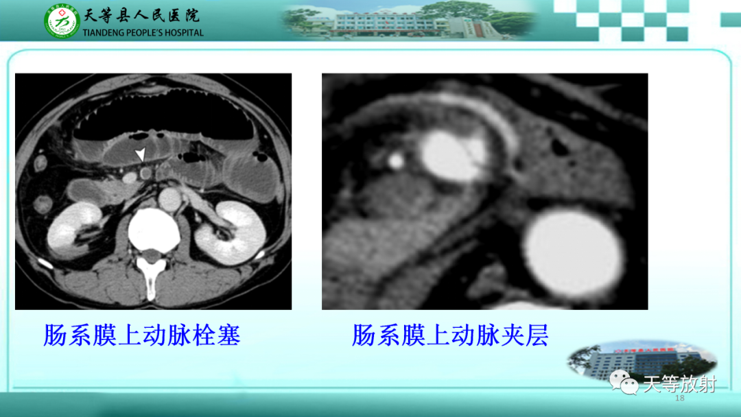 影像PPT - 【PPT】缺血性肠病的影像学表现-17
