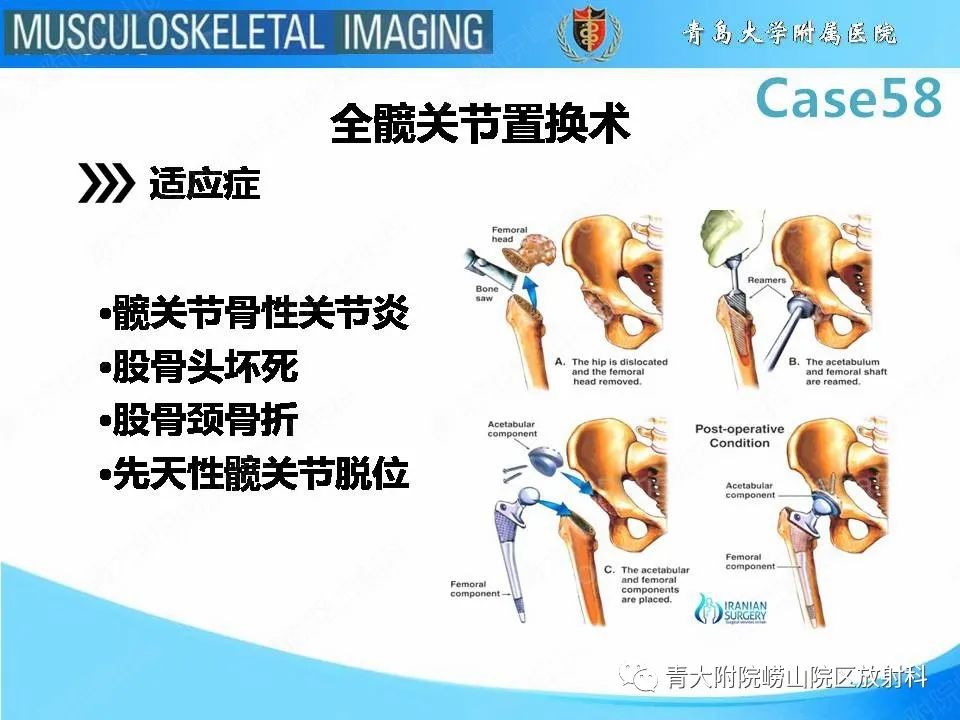 影像PPT - 【PPT】髋关节手术并发症-5
