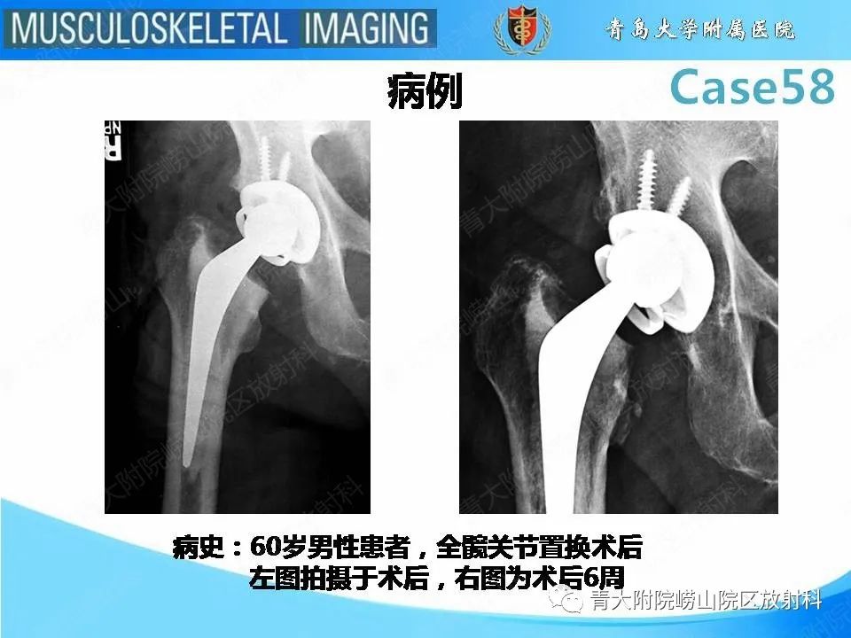 影像PPT - 【PPT】髋关节手术并发症-2
