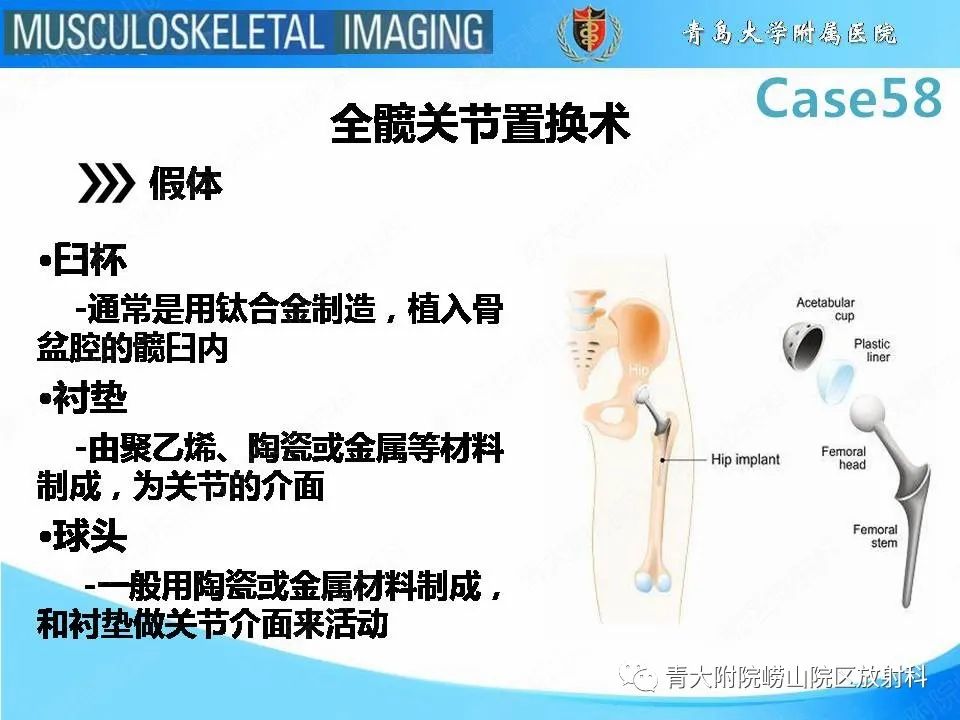 影像PPT - 【PPT】髋关节手术并发症-6