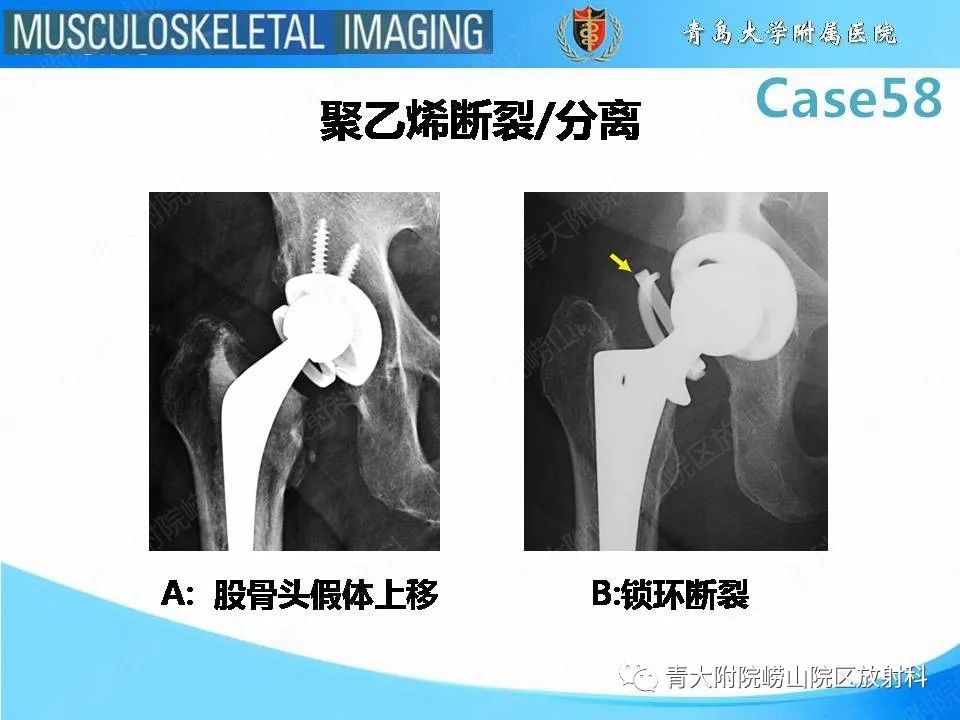 影像PPT - 【PPT】髋关节手术并发症-10