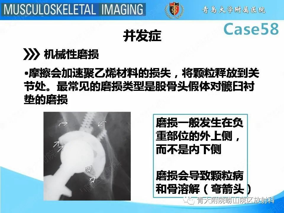 影像PPT - 【PPT】髋关节手术并发症-13