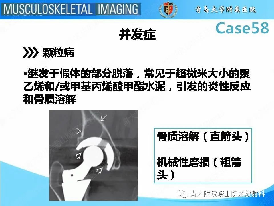 影像PPT - 【PPT】髋关节手术并发症-14