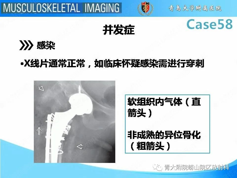 影像PPT - 【PPT】髋关节手术并发症-15