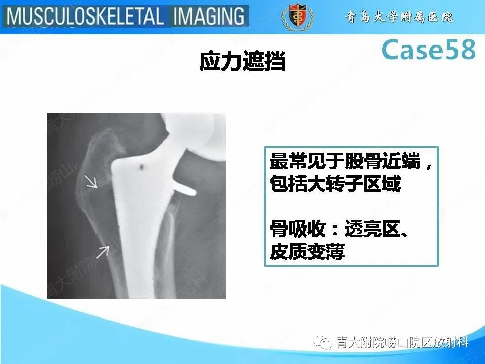 影像PPT - 【PPT】髋关节手术并发症-17