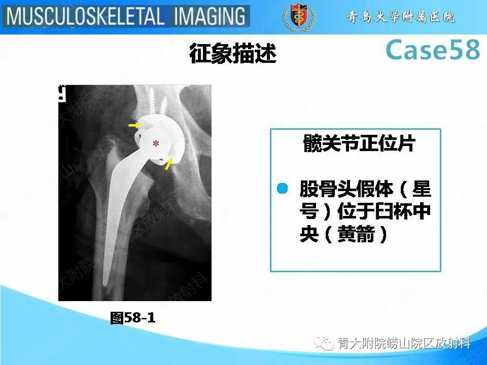 影像PPT - 【PPT】髋关节手术并发症-24