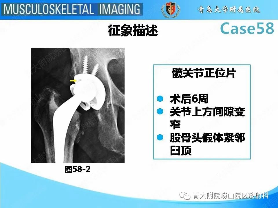 影像PPT - 【PPT】髋关节手术并发症-25