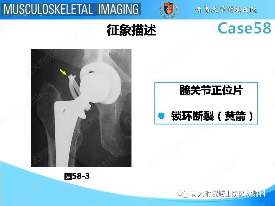 影像PPT - 【PPT】髋关节手术并发症-26