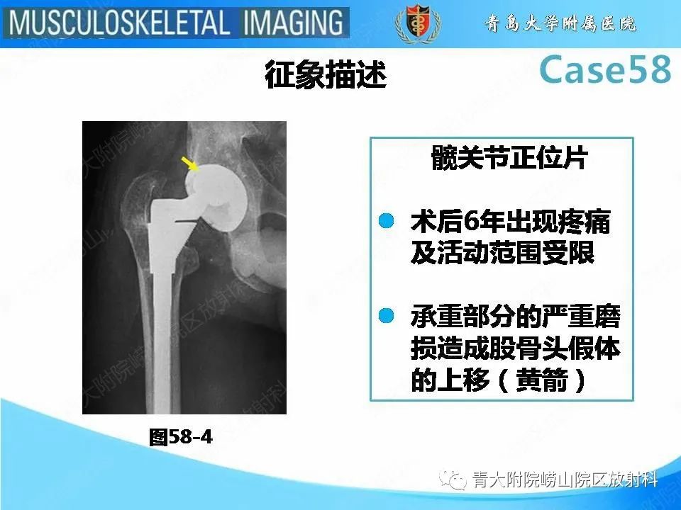 影像PPT - 【PPT】髋关节手术并发症-27