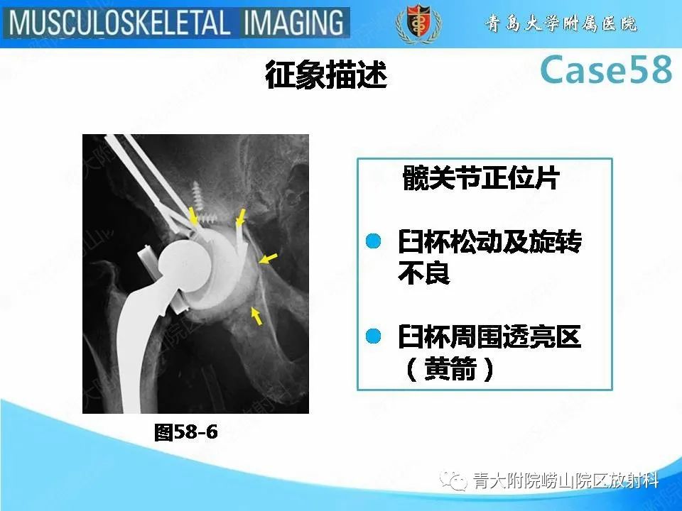 影像PPT - 【PPT】髋关节手术并发症-29