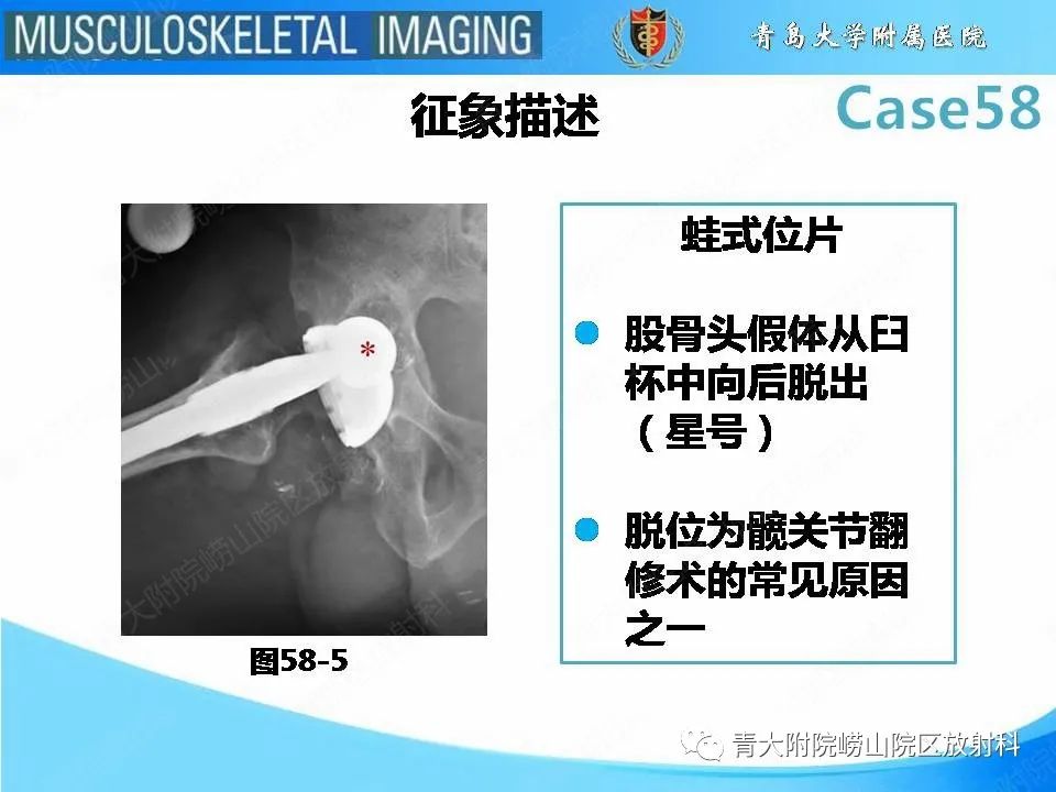 影像PPT - 【PPT】髋关节手术并发症-28
