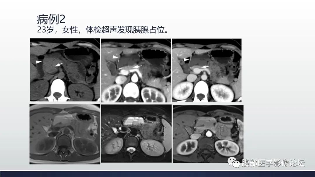 影像PPT - 【病例】胰腺血管瘤1例CT及MR影像-2