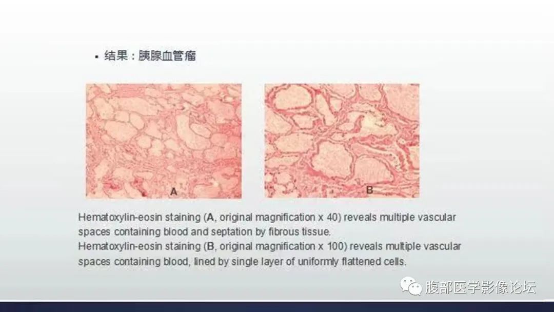 影像PPT - 【病例】胰腺血管瘤1例CT及MR影像-3
