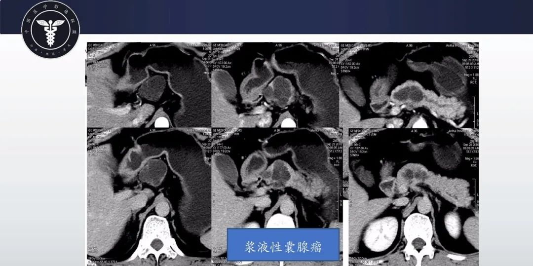 影像PPT - 【病例】胰腺血管瘤1例CT及MR影像-9