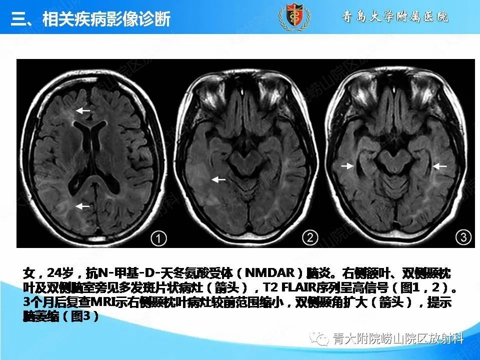 影像PPT - 【PPT】自身免疫性脑炎的影像诊断与鉴别-15