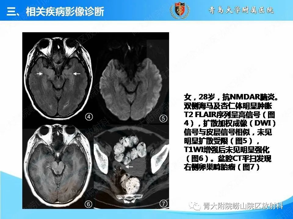 影像PPT - 【PPT】自身免疫性脑炎的影像诊断与鉴别-16