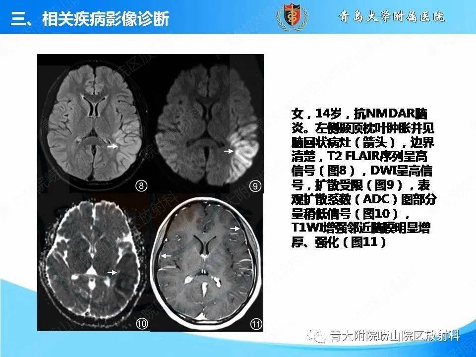 影像PPT - 【PPT】自身免疫性脑炎的影像诊断与鉴别-17