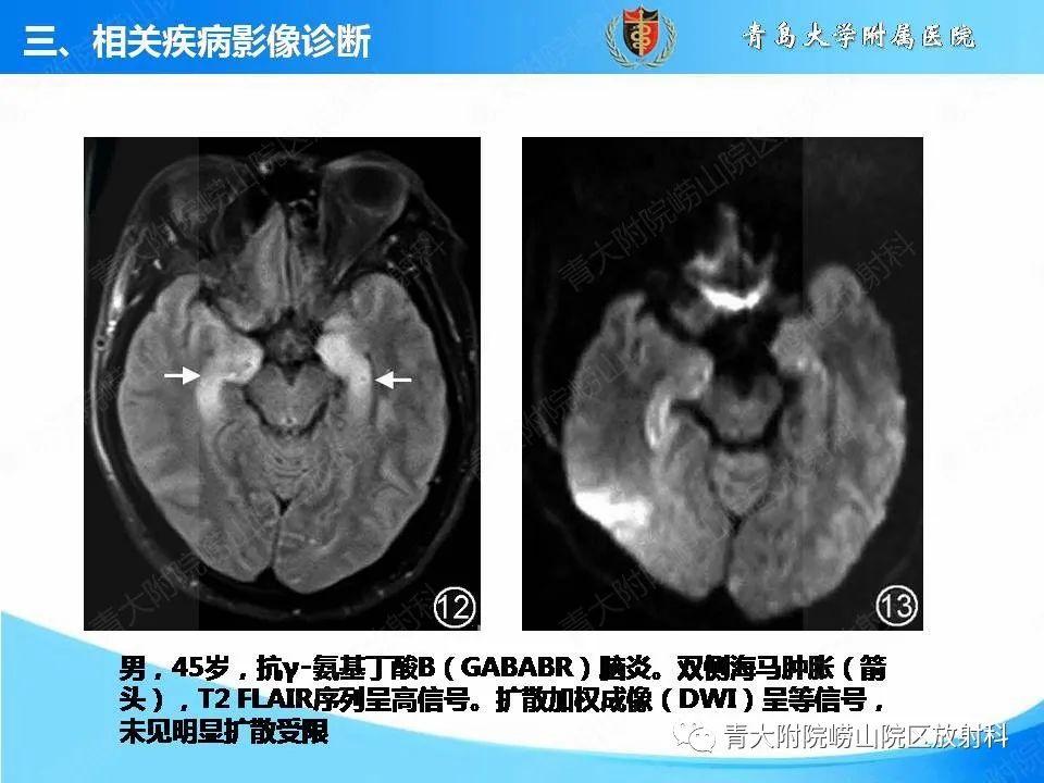 影像PPT - 【PPT】自身免疫性脑炎的影像诊断与鉴别-19