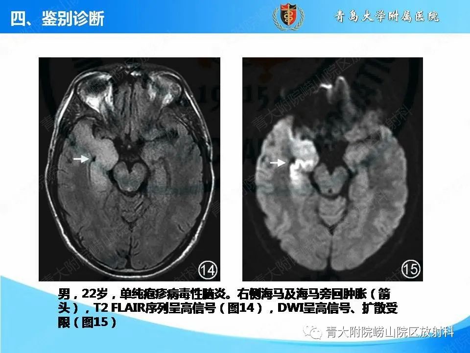 影像PPT - 【PPT】自身免疫性脑炎的影像诊断与鉴别-22