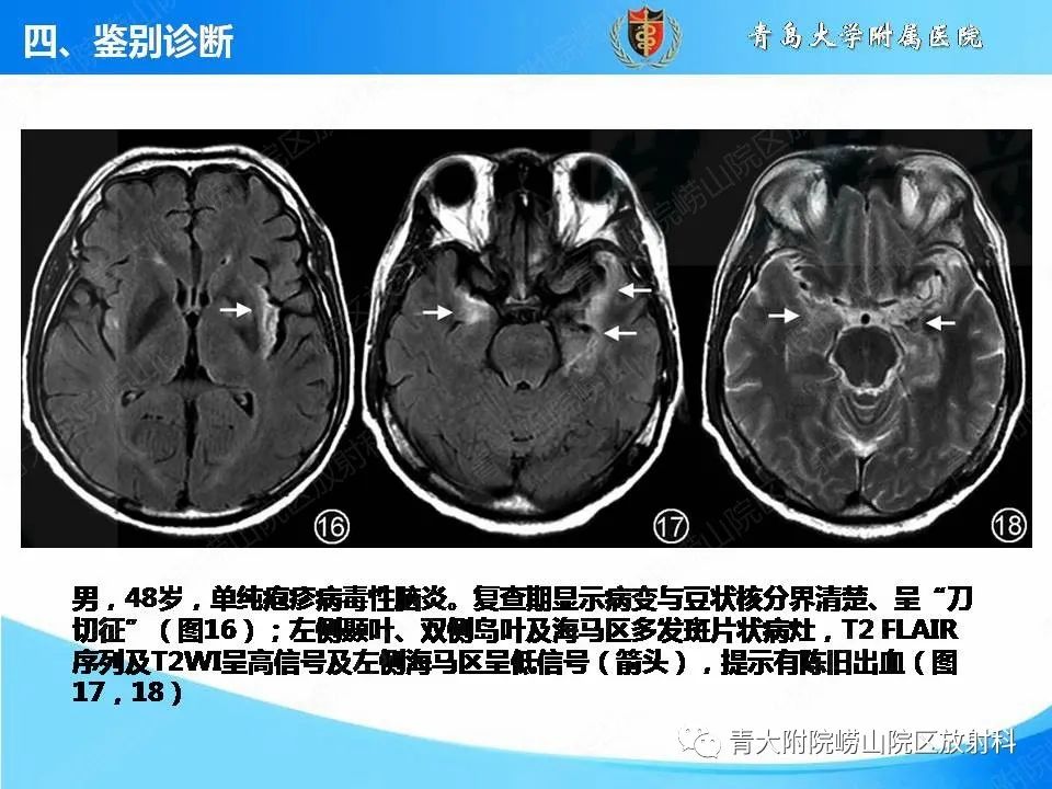 影像PPT - 【PPT】自身免疫性脑炎的影像诊断与鉴别-23