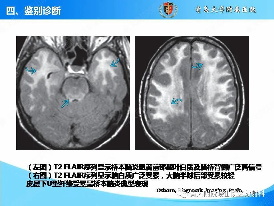 影像PPT - 【PPT】自身免疫性脑炎的影像诊断与鉴别-25