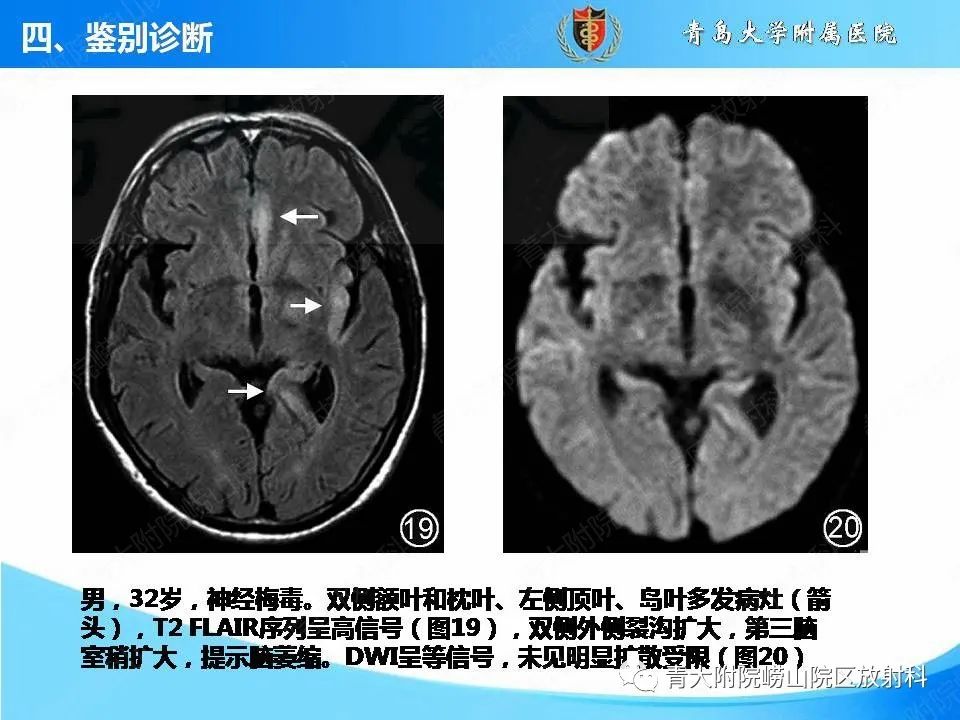 影像PPT - 【PPT】自身免疫性脑炎的影像诊断与鉴别-27
