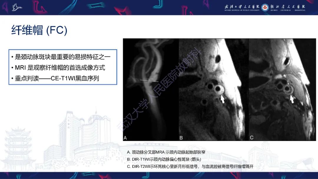 影像PPT - 【PPT】颈动脉斑块HR-MR影像判读-16