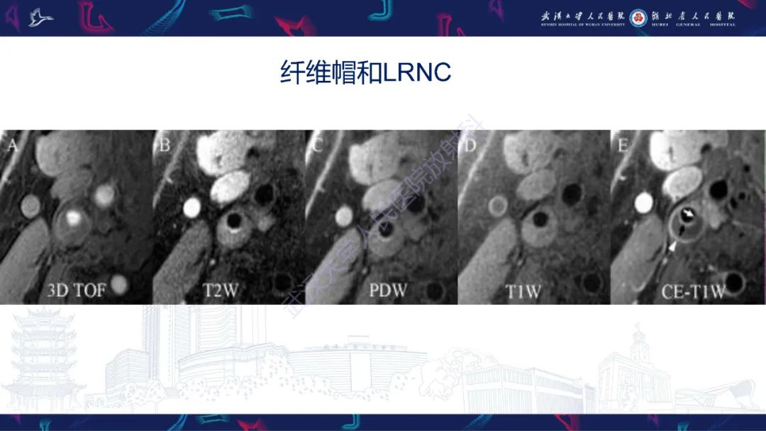 影像PPT - 【PPT】颈动脉斑块HR-MR影像判读-17