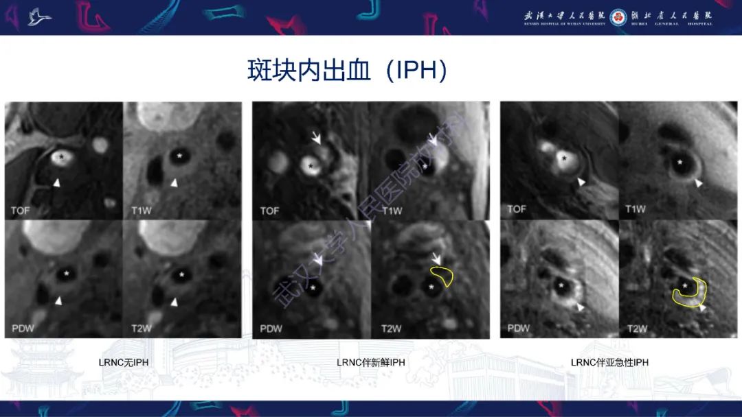 影像PPT - 【PPT】颈动脉斑块HR-MR影像判读-21