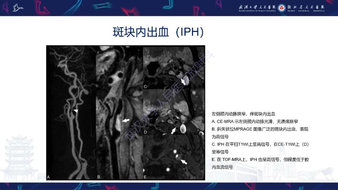 影像PPT - 【PPT】颈动脉斑块HR-MR影像判读-20