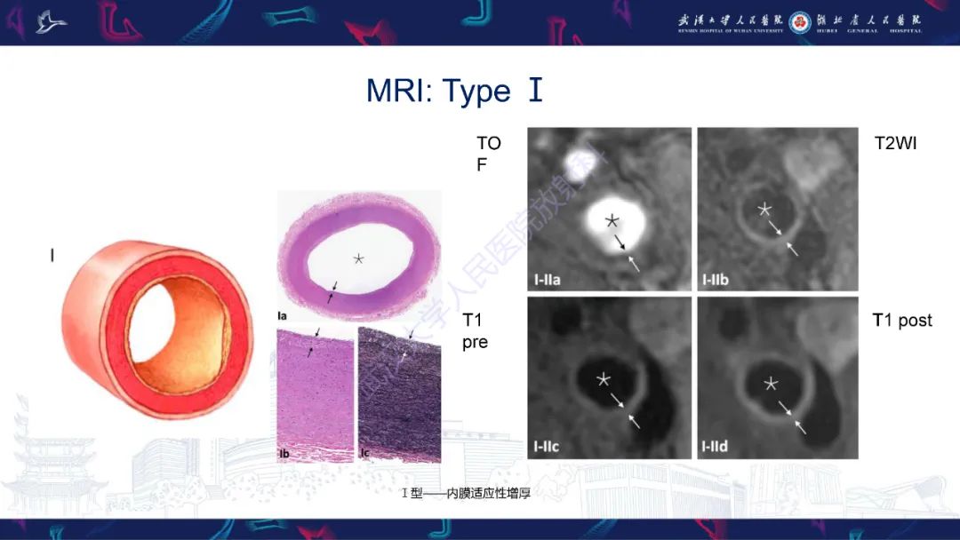 影像PPT - 【PPT】颈动脉斑块HR-MR影像判读-25