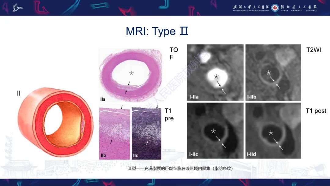 影像PPT - 【PPT】颈动脉斑块HR-MR影像判读-26