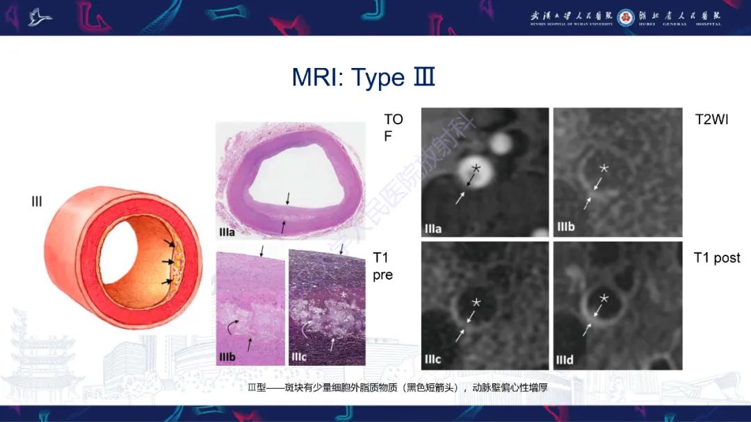 影像PPT - 【PPT】颈动脉斑块HR-MR影像判读-27