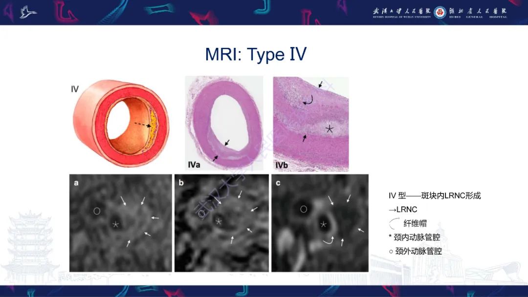 影像PPT - 【PPT】颈动脉斑块HR-MR影像判读-28