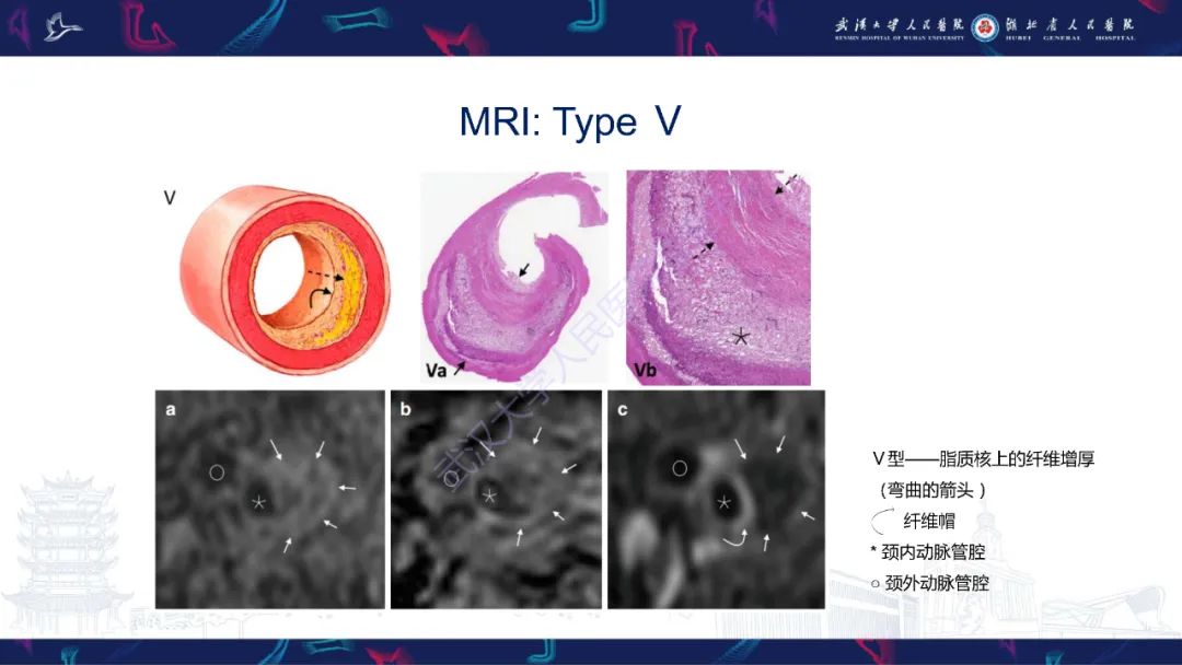 影像PPT - 【PPT】颈动脉斑块HR-MR影像判读-29