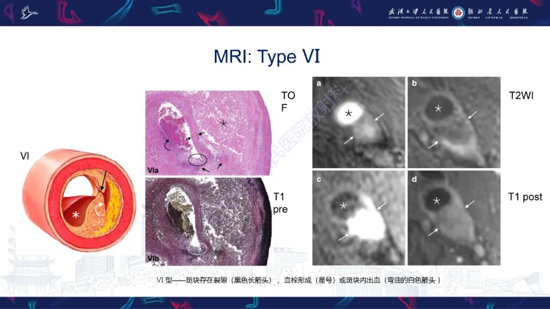 影像PPT - 【PPT】颈动脉斑块HR-MR影像判读-30