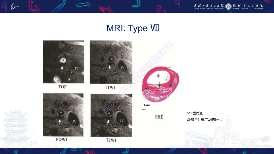 影像PPT - 【PPT】颈动脉斑块HR-MR影像判读-31