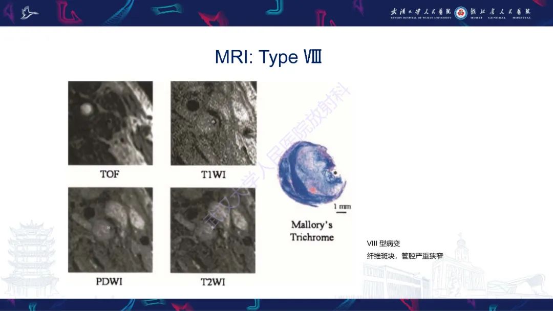 影像PPT - 【PPT】颈动脉斑块HR-MR影像判读-32