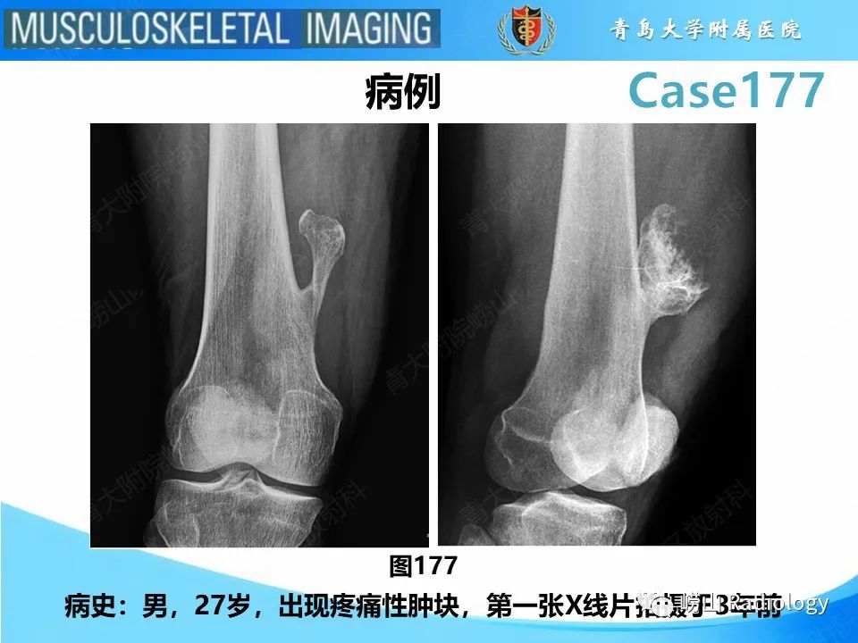 影像PPT - 【PPT】骨软骨瘤-恶变-2