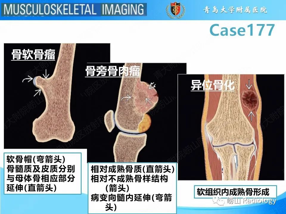 影像PPT - 【PPT】骨软骨瘤-恶变-5