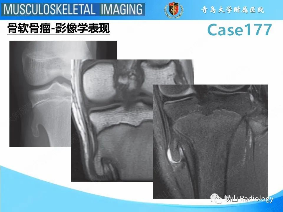影像PPT - 【PPT】骨软骨瘤-恶变-8
