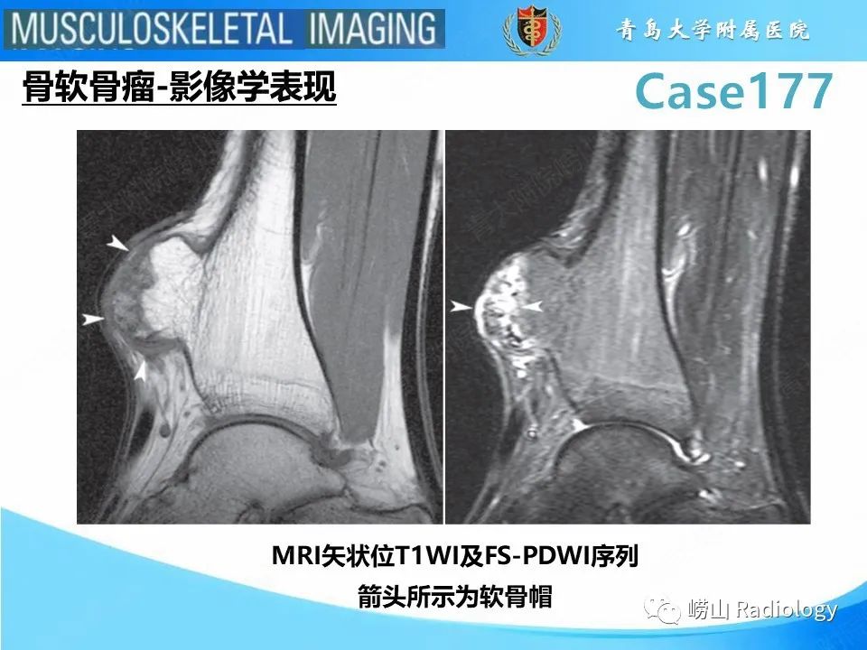 影像PPT - 【PPT】骨软骨瘤-恶变-9