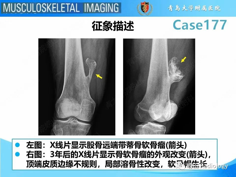 影像PPT - 【PPT】骨软骨瘤-恶变-13