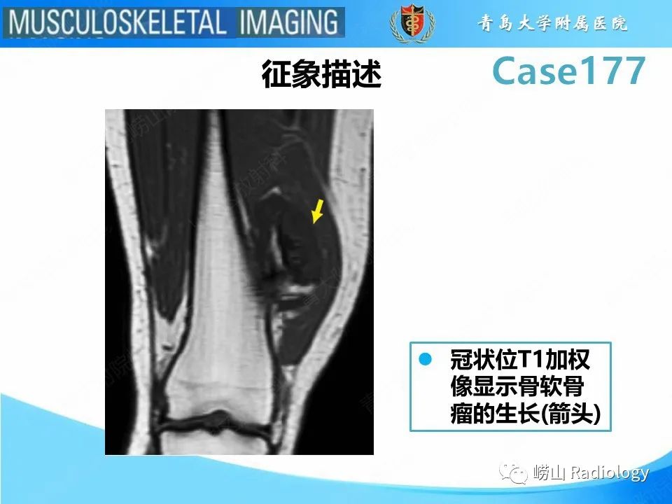 影像PPT - 【PPT】骨软骨瘤-恶变-14