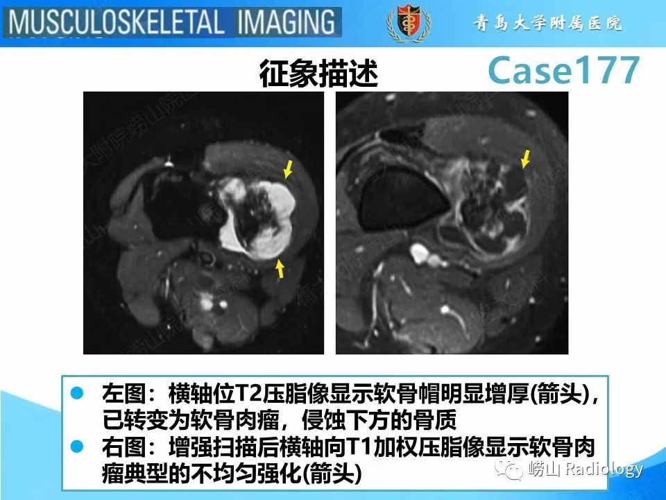 影像PPT - 【PPT】骨软骨瘤-恶变-15