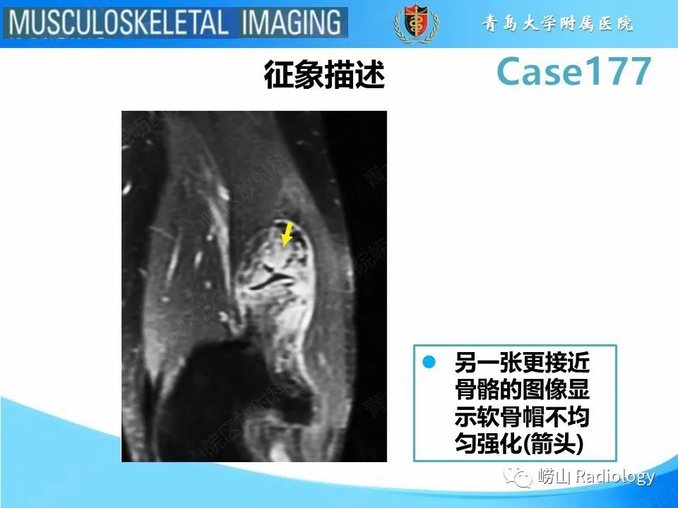 影像PPT - 【PPT】骨软骨瘤-恶变-16