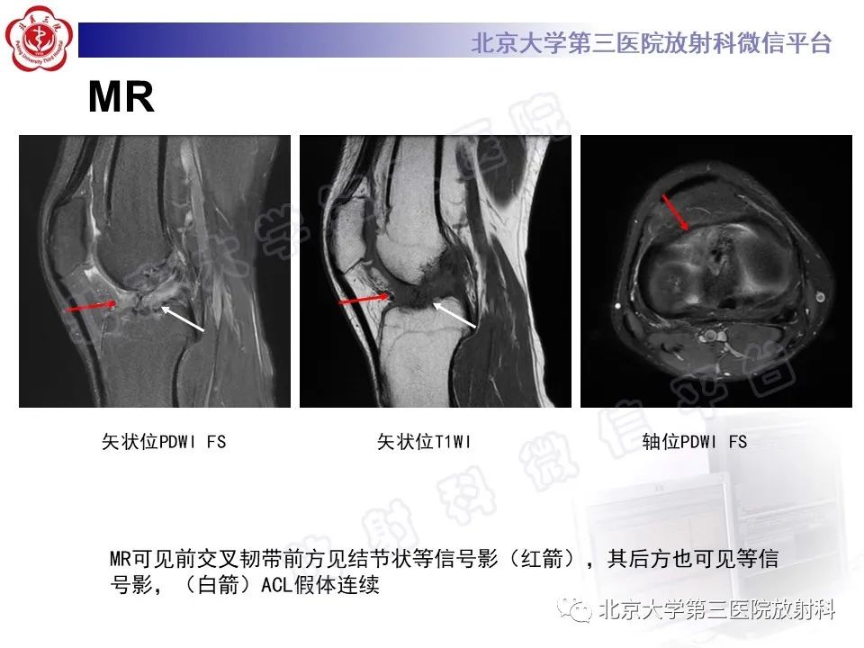 影像PPT - 【PPT】膝关节CYCLOPS病变-4